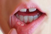 Các vết lở miệng có nguy hiểm không ?